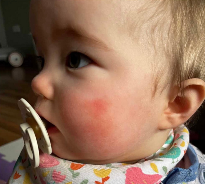 Tips for eczema management in children and babies