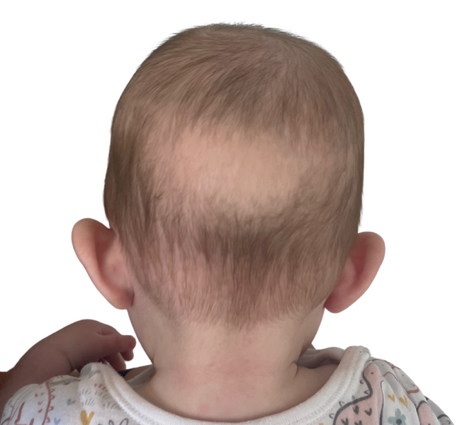 Top tips for preventing the baby bald patch